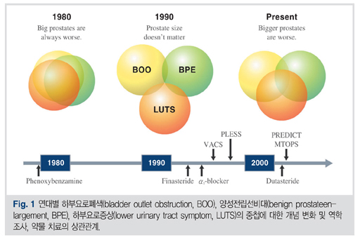 양성전립선비대비뇨기과 진단검사방법과 미국 FDA 승인치료