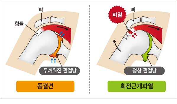 발목인대 파열수술, 증상 심해지면 10