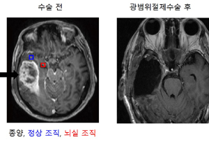 광범위절제술로 종양 조직 이외에 기능이 없는 정상조직과 뇌실주변 조직을 획득(자료 · 설명 제공: 세브란스)