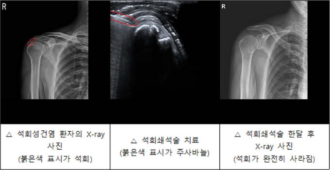 석회쇄석술 치료 전중후 X-ray 사진