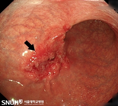위암 환자의 내시경 영상 